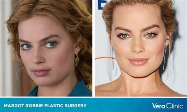 Unveiling The Truth: Margot Robbie's Nose Job Rumors